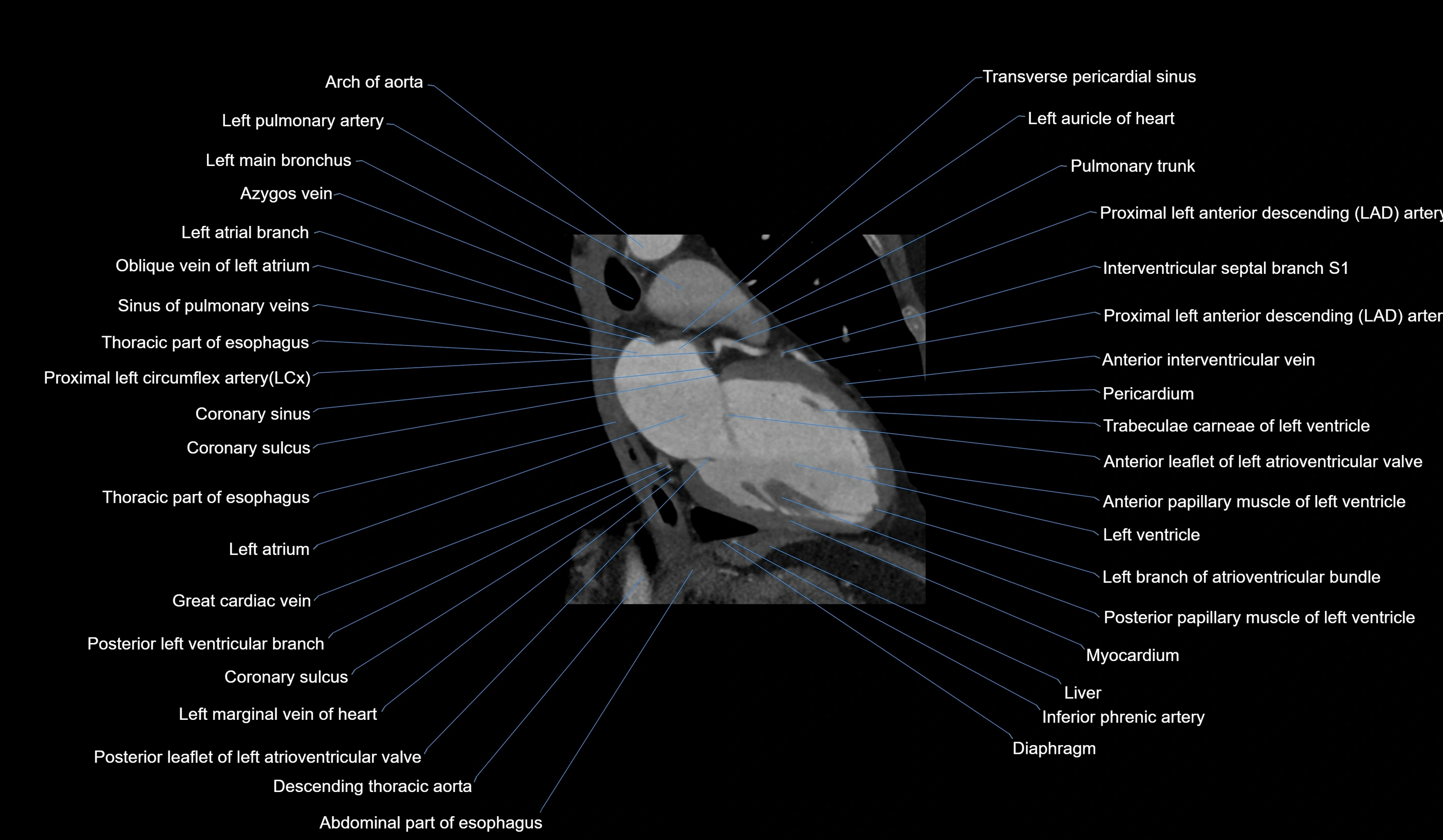 CT heart (coronary angiogram) 2 chamber view cross sectional anatomy labelled radiology image-00015.webp